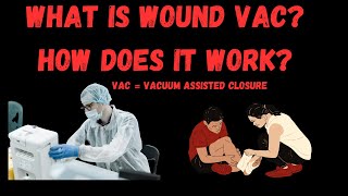 How Wound VAC Therapy Heals Wounds Faster [upl. by Damiano]