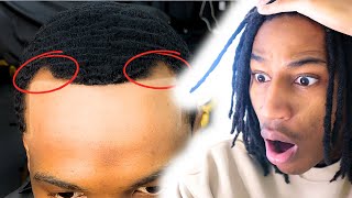 The quotGreatestquot Hairline Ever 100 not a misleading title YouTube [upl. by Yur]