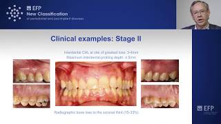 Assessing periodontitis clinical examples amp key points  tutorial by Mariano Sanz [upl. by Jacenta618]