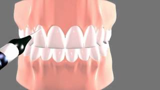 Gingivectomy Laser [upl. by Eng219]