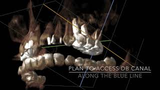 CBCT guided endodontic access [upl. by Ynetsed]