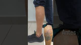 Remoção de Tatuagem com laser de picossegundos PicoSure [upl. by Rizzo783]