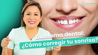 Diastema dental Como corregir tu sonrisa [upl. by Shoemaker]