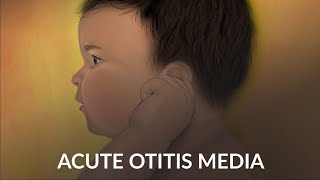 Acute Otitis Media by A Ruan J Cheng  OPENPediatrics [upl. by Aerdnua712]