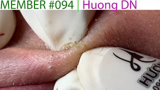 Acne Treatment Huong Da Nang 094  Member  Huong [upl. by Blount]