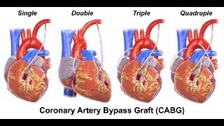 Coronary artery bypass surgery or OpenHeart Surgery in Bangladesh FROM 130000 TO 550000 TAKA [upl. by Pompea673]