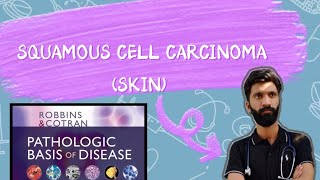 SQUAMOUS CELL CARCINOMA OF SKIN PATHOLOGY ROBBINS BASIS [upl. by Erodroeht]