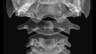 Odontoid Positioning tutorial [upl. by Nivel]