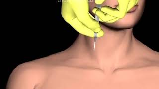 Internal Jugular Vein IJV Access in Hypovolemic Patient Animation by Cal Shipley MD [upl. by Kilian]