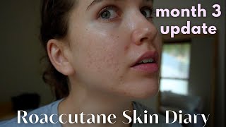 Roaccutane Daily Skin Diary  Month 3  The Purge Continues Low Dose  ft Temu Haul [upl. by End]