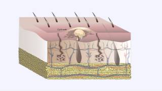 Common Skin Disorders Cysts [upl. by Ruzich]