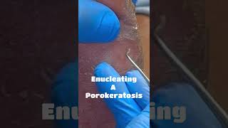 Enucleating A Porokeratosis [upl. by Barsky]