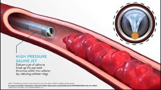 JETi Hydrodynamic Thrombectomy System Method of Action MOA Animation [upl. by Avika845]