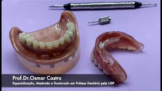 Prótese fixa e removível sobre implantes principais diferenças [upl. by Felder]