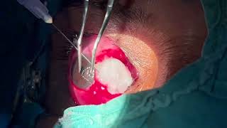 Modified Pterygium Surgery  Wills Hospital USA with Conjuctival Autograft using Mitomycin C [upl. by Seiuqram]