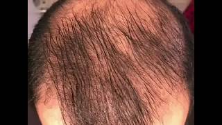 8 months using minoxidil  Rogaine 5 Before amp After results [upl. by Ainer67]