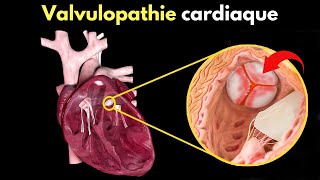 Comment se produit la valvulopathie cardiaque  Symptômes diagnostic et traitement [upl. by Bron]