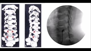 How to perform Stellate Ganglion Block Treatment [upl. by Hartill]