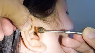 Removing One HUGE EARWAX Stuck in Womans Ear [upl. by Enrika396]