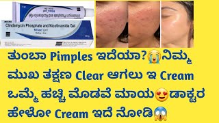 Nilac Cream Review in kannadaUsesside effectssafety Advice acneremoval pimplefree skincare [upl. by Letsirk]