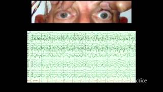 Alternating ictal and postictal nystagmus [upl. by Lolita]