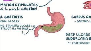 Helicobacter pylori microbiology and pathology [upl. by Neale]