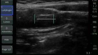 CIMT Exam  Performing Measurements  Sonosite [upl. by Princess]