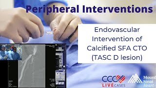 Endovascular Intervention of Calcified SFA CTO TASC D lesion  December 18 2013 Live Case Video [upl. by Nomit140]