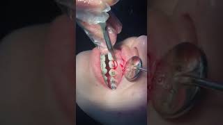 Gingivectomy for orthodontics treatment [upl. by Lorsung887]