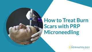 How to Treat Burn Scars with PRP Microneedling [upl. by Akcirret]