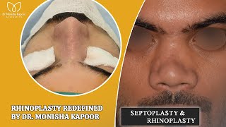 Complicated Revision Rhinoplasty Case Performed by Dr Monisha Kapoor explore result vlog [upl. by Meihar]