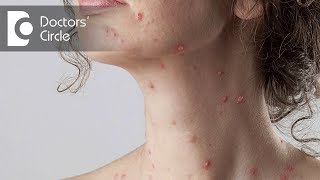 Which medicine can I use to remove chickenpox spots  Dr Vijaya Raghava Reddy [upl. by Enier846]