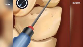 Knee Treatment Surgery With Anthroscope surgeryeducation kneepain kneesurgeon surgeon [upl. by Curhan]