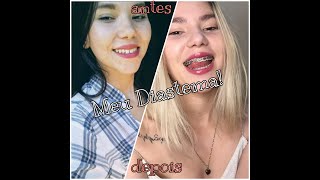 Diastema Dentes separados Antes e depois do aparelho 😯🥰 [upl. by Anovad]