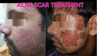 Laser acne scar removal  Before and after results  Laser treatment for scars [upl. by Burnaby]