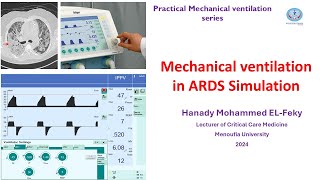 Simulation of Ventilator settings in ARDS in Arabic [upl. by Hecht]