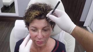 InOffice Brow Lift in NJ with PDO Threads [upl. by Leach]