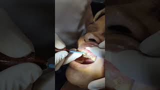 Gingivectomy RFcauterycrownlengthening [upl. by Asiralc]