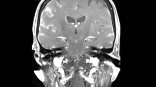 Leptomeningeal Carcinomatosis [upl. by Berrie]