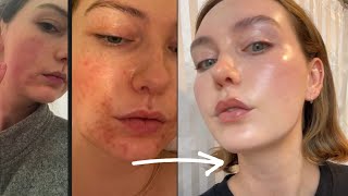 From rosacea  acne to glass skin — this skincare works [upl. by Garber677]