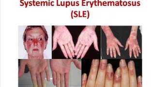 Systemic Lupus Erythematosus  SLE  Causes Signs amp Symptoms  Treatment [upl. by Esra]