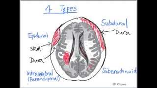 Intracranial Bleed  Part 1 [upl. by Aiek]