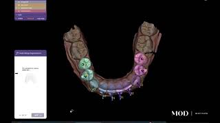 exocad detachable dies for veneer cases in under 5 minutes [upl. by Alaine492]