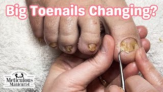 👣Are Your Big Toenails Changing and You Dont Know How to Fix Them👣 [upl. by Etteyniv839]