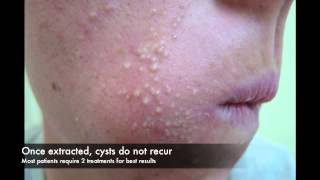 Acne cyst laser treatment [upl. by Mclyman]