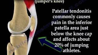 Patellar Tendonitis Jumpers Knee  Everything You Need To Know  Dr Nabil Ebraheim [upl. by Elspet925]