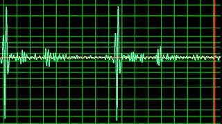 Aortic Regurgitation Ejection Systolic Murmur normal speed [upl. by Pronty274]