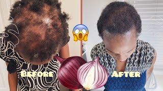 How I Grew My Bald Patches 1 onionjuice [upl. by Fisch46]