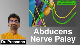 Abducens Nerve Palsy [upl. by Rehprotsirhc293]