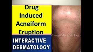 Drug induced acneiform eruption [upl. by Zanlog574]